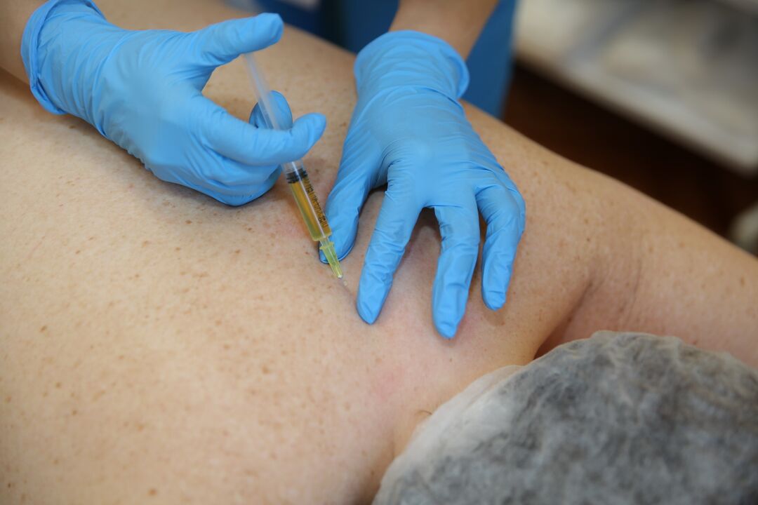 inxeccións de condroprotectores para as costas