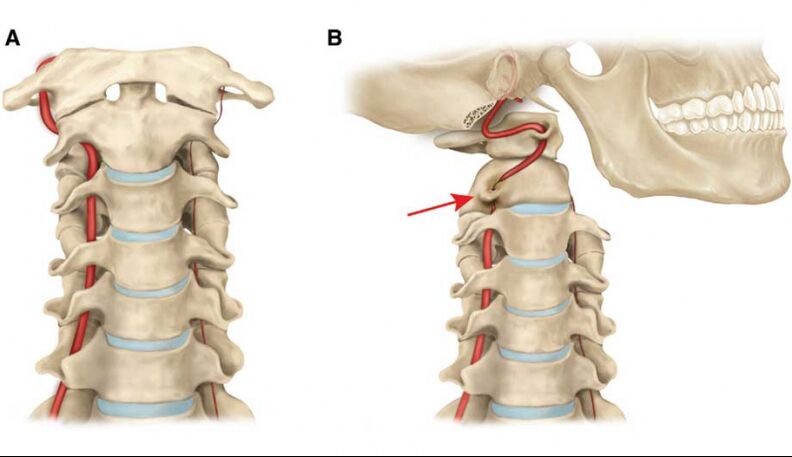 Curso da arteria vertebral