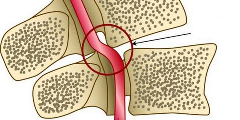 Deformación da arteria vertebral por inestabilidade vertebral